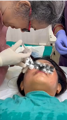 Fillers Training
